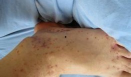 性紫癜可以吃葫芦瓜吗,葫芦瓜的适宜性分析