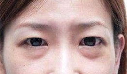 吃瓜去眼袋的功效,美丽从“眼”开始