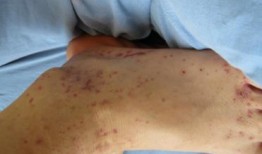 性紫癜可以吃葫芦瓜吗,葫芦瓜的适宜性分析